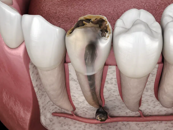 마곡역치과_3. 신경치료 후 통증, 오래가는 경우는 따로 있습니다 관련 이미지 1