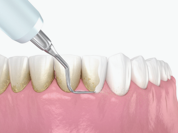 마곡역치과_ 1. 스케일링 꼭 받아야 하나요? 치석 제거부터 잇몸병 예방까지 효과 총정리 관련 이미지 6