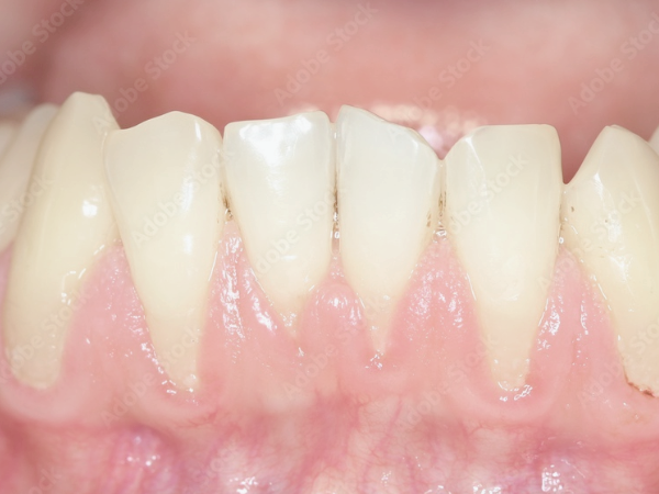 마곡동치과_5. 중년기 초입(30~40대) 치아 잇몸 변화와 구강관리 포인트 관련 이미지 2