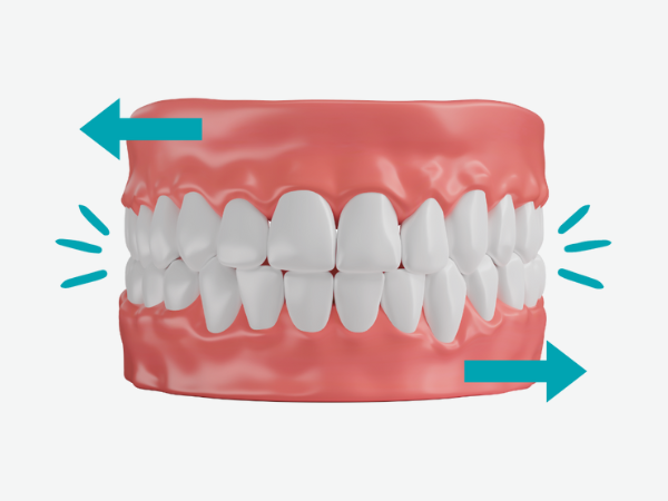 마곡역치과_4. 브릿지 치료 단점과 수명, 얼마나 오래 사용할 수 있을까요? 관련 이미지 5