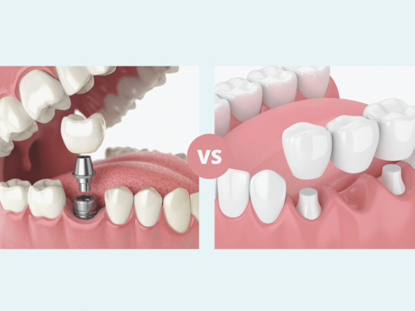 [ 마곡동치과_치아 상실 4 ] 브릿지 치료, 빠르게 해결 가능하지만 괜찮을까요? 관련 이미지 5