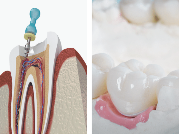 마곡역치과_&ldquo;금의 깊이가 다르면 치료도 달라집니다!&rdquo;[3. 치아 금(균열) 치료] 관련 이미지 8