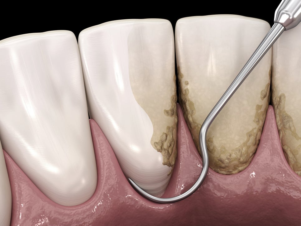 마곡동치과_4. 스케일링 오해와 진실? 치아 깎인다? 시리다? 진짜는 따로 있습니다. 관련 이미지 4
