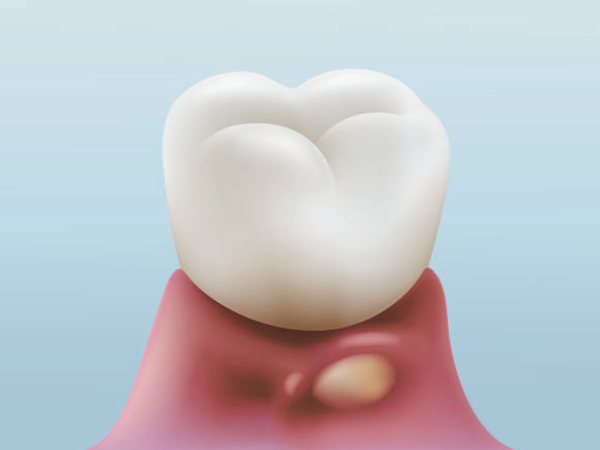 마곡동치과_&ldquo;이건 단순한 붓기가 아닙니다!" [ 2. 잇몸 고름 주머니 증상 ] 관련 이미지 1