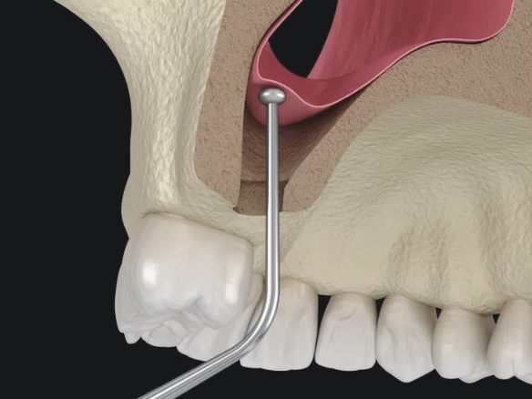 마곡역치과_2. 상악동 거상술 치조정 접근법, 언제 어떻게 진행될까? 관련 이미지 2