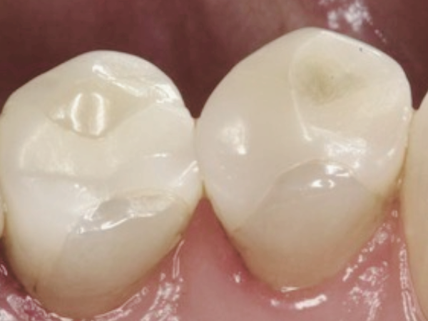 마곡동치과_2. 인레이 재료 종류와 비용 비교 [ 골드, 세라믹, 복합레진 특징 총정리 ] 관련 이미지 3