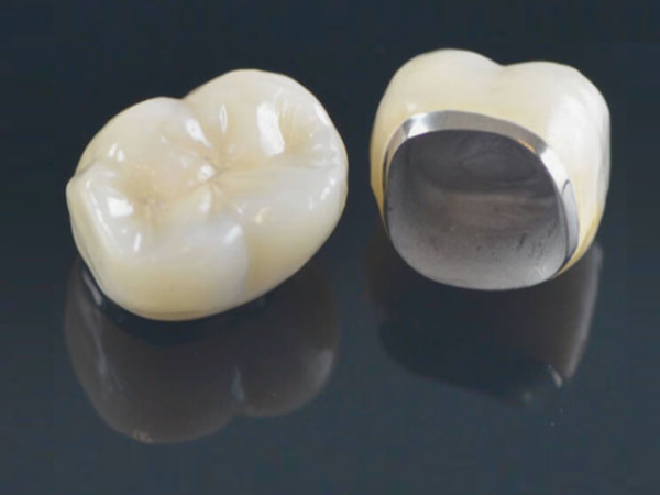 마곡동치과_2. 치과 크라운 보철의 종류별 장단점과 비용 관련 이미지 4