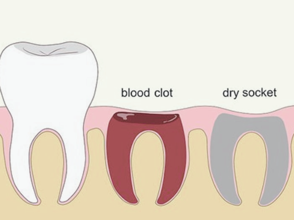 마곡동치과_7. 사랑니 발치 후 생기는 드라이소켓, 원인과 증상부터 예방법까지 총정리 관련 이미지 1