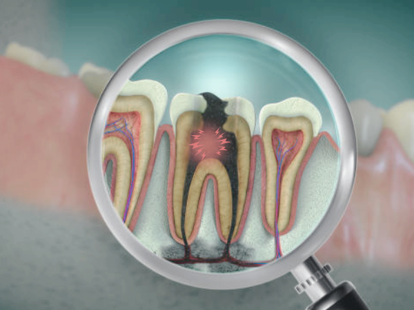 마곡역치과_3. 밤에 치통이 심해지는 이유? 치수염 통증 특징 관련 이미지 2