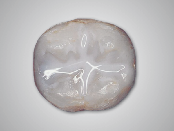 Maggok Station Dental Clinic_“Prevent Cavities Before They Start” [1. What Is Pit and Fissure Sealant?] image 2