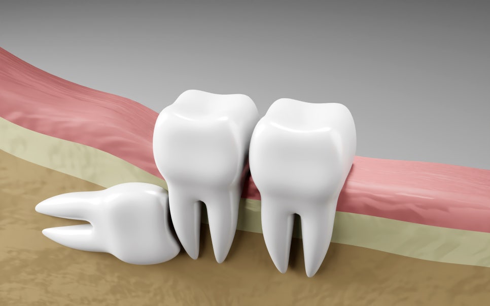 [ Magok Dental Clinic_03 ] I Left My Wisdom Tooth Alone, and It Even Caused Decay in the Tooth Next to It - What Happens When You Leave It Untreated image 1