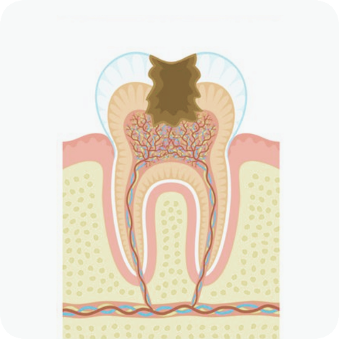 마곡동치과_"방치하면 임플란트까지?" [ 3. 충치 진행 단계별 치료 ] 관련 이미지 6