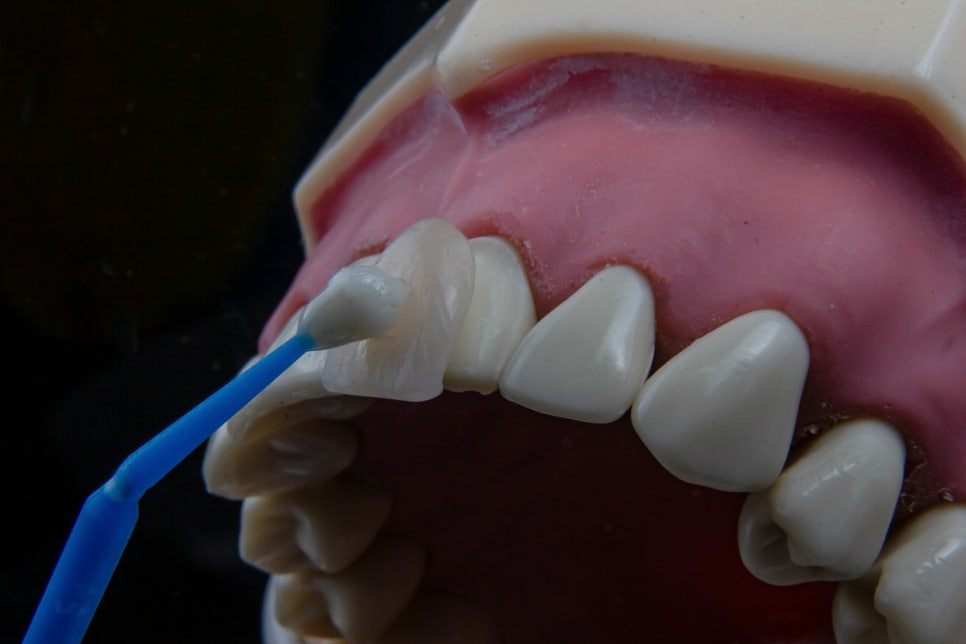 [ Magok Veneers_03 ] When Are Veneers Suitable? A Summary of Indications image 4