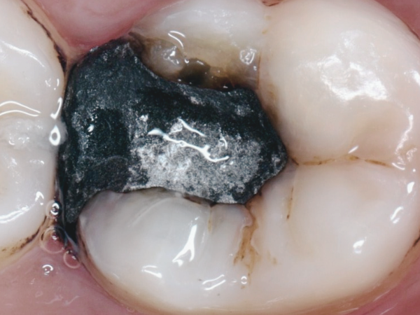 마곡치과_1. 아말감 충전, 아직 있어도 괜찮을까요? 수은 걱정에 대한 현실 답변 관련 이미지 4