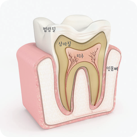 마곡동치과_"방치하면 임플란트까지?" [ 3. 충치 진행 단계별 치료 ] 관련 이미지 1