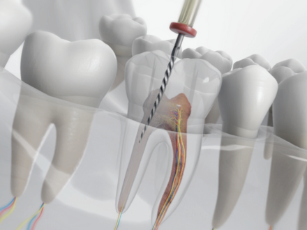 마곡동치과_ 1. 크라운 치료가 필요한 5가지 경우 관련 이미지 5