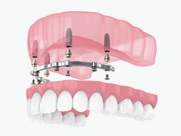 마곡동치과_ &ldquo;씹고 뜯고 맛보는 즐거움!&rdquo; [ 3. 임플란트 틀니의 장점 ] 관련 이미지 1