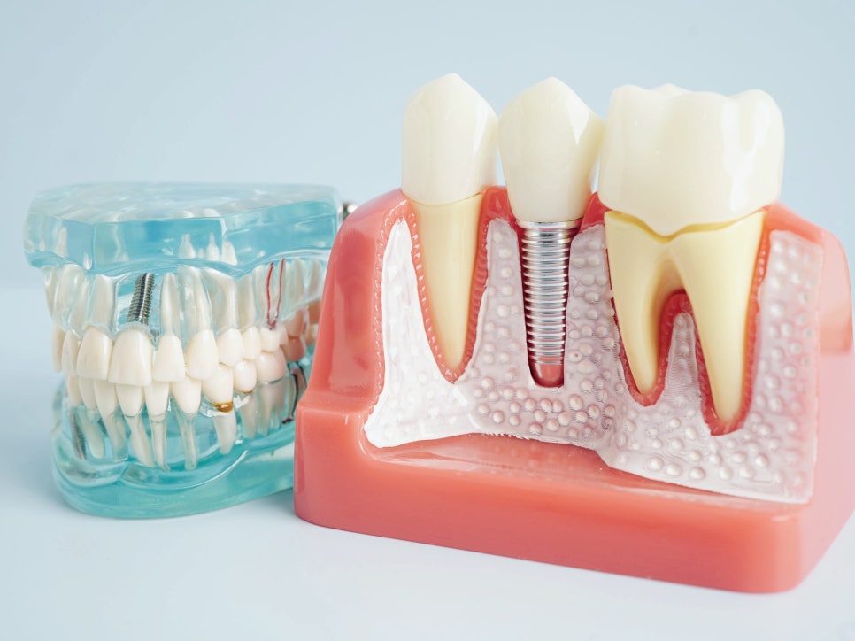 Mokgok Station Dentist_6. A Realistic Guide to When You Can Start Exercising After Implant Surgery image 1