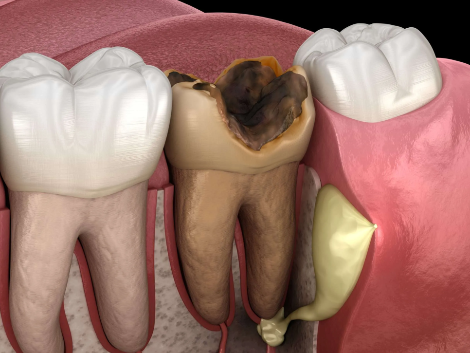 마곡치과_3. 씹을 때 아픈 치아, 그냥 참아도 괜찮을까요? 방치하면 생기는 문제 관련 이미지 2
