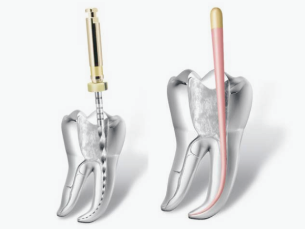마곡역치과_ "신경치료 후 치아, 왜 꼭 &lsquo;씌워야&rsquo; 할까요?" [7. 크라운 보철의 중요성] 관련 이미지 1