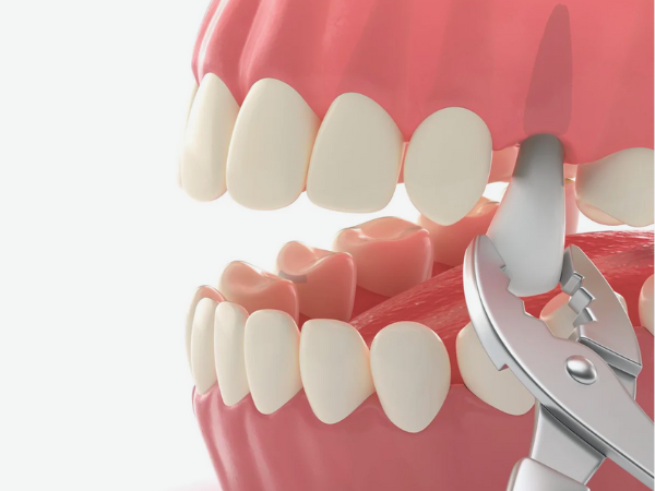 마곡동치과_&ldquo;그냥 두면 괜찮을 줄 알았죠?&rdquo; [3. 치근단절제술 미루면 생기는 문제] 관련 이미지 4