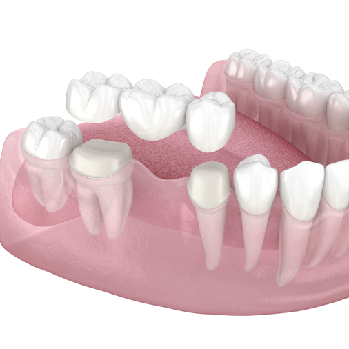 마곡동치과_1. 브릿지 치료란 무엇인가요? 임플란트, 틀니와 차이부터 정리합니다 관련 이미지 4