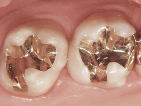 마곡동치과_2. 인레이 재료 종류와 비용 비교 [ 골드, 세라믹, 복합레진 특징 총정리 ] 관련 이미지 1