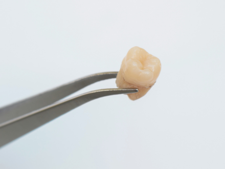 마곡역치과_6. 사랑니 발치 후 통증, 정상일까? 통증 지속 기간과 관리법 관련 이미지 2