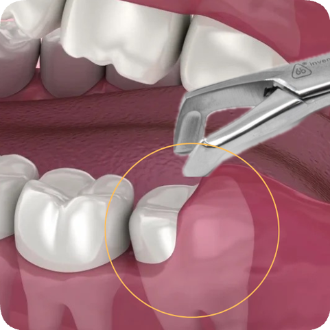 마곡동치과_10. 사랑니 발치 비용, 진짜 얼마일까요? 건강보험 적용으로 부담 덜어드립니다! 관련 이미지 3