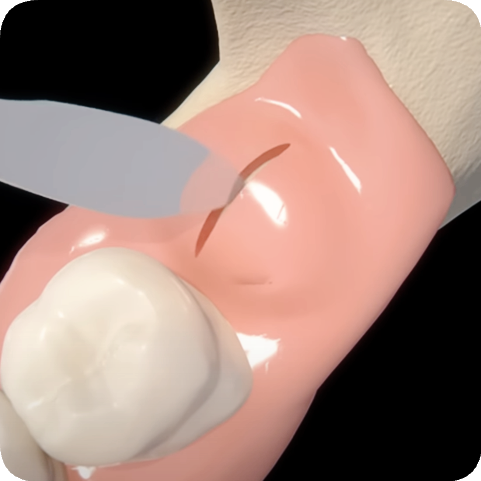 마곡역치과_4. 사랑니 발치, 어떤 과정을 거치나요? 관련 이미지 3