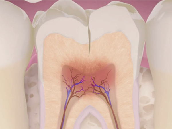 마곡역치과_&ldquo;금의 깊이가 다르면 치료도 달라집니다!&rdquo;[3. 치아 금(균열) 치료] 관련 이미지 5