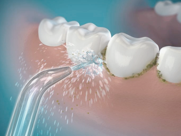 마곡역치과_ 4. 구강세정기 꼭 써야 할까요? 물치실 효과와 올바른 사용법 관련 이미지 1