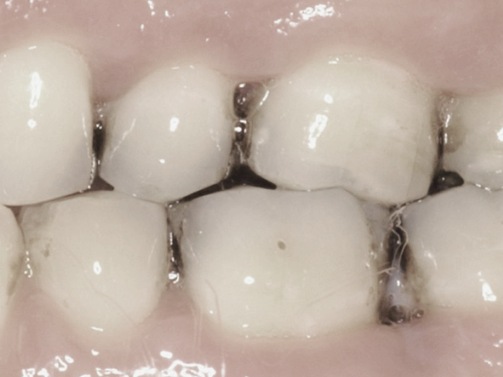 마곡역치과_6. 중장년기(50~60대) 구강 변화와 치아 상실 예방 관리법 관련 이미지 2