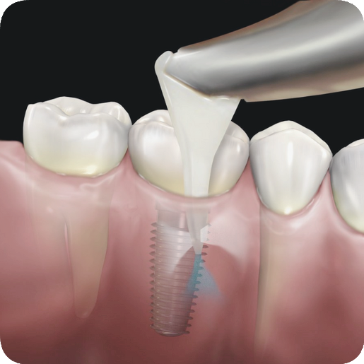 마곡동치과_&ldquo;지금도 늦지 않았다!" [ 4. 임플란트 주위염 치료법 ] 관련 이미지 1