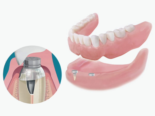 마곡동치과_ &ldquo;내 입에 딱! 맞는 선택은?&rdquo; [ 5. 임플란트 틀니 종류와 특징 ] 관련 이미지 4