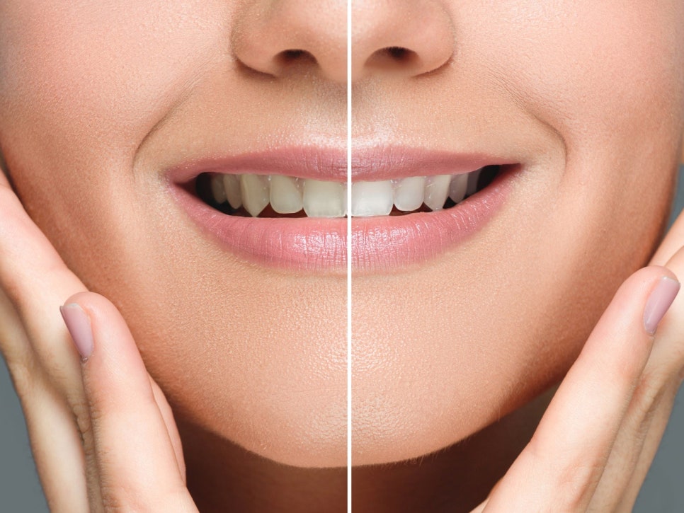 마곡역치과_ 하얀 치아로 가는 가장 빠른 길! [ 3. 생활치 전문가 미백의 특징과 과정 ] 관련 이미지 7