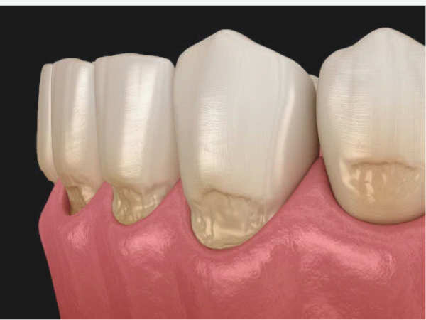 마곡역치과_ 2. 글래스아이오노머(GI) 적응증 관련 이미지 3