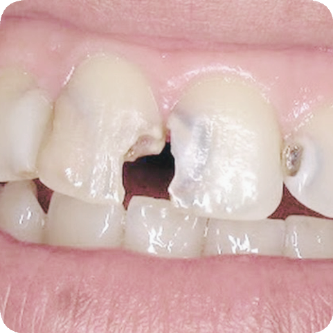 마곡동치과_2. 무삭제 라미네이트가 불가능한 경우 관련 이미지 3