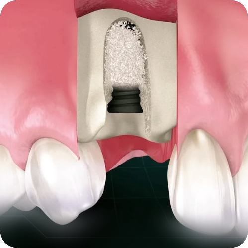 마곡동치과_&ldquo;지금도 늦지 않았다!" [ 4. 임플란트 주위염 치료법 ] 관련 이미지 3