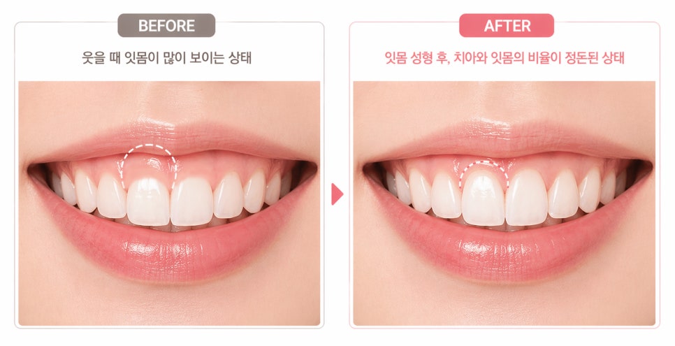 [ Magok Station Dental _ Wedding Glow ] Wedding Smile Prep Every Prospective Bride and Groom Should Know image 6