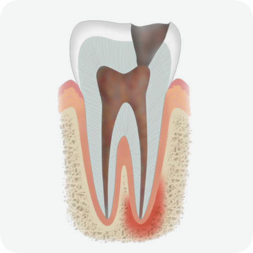 마곡동치과_ "자연치아 지키는 골든타임" [ 1. 신경치료 꼭 받아야 하는 5가지 경우 ] 관련 이미지 4