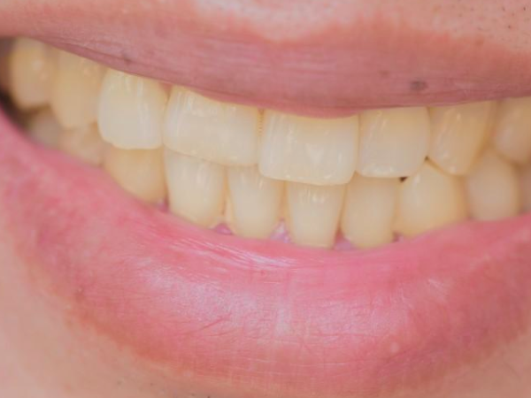 마곡동치과_ "찬물에 시리고, 이가 짧아졌다면?"[3. 치아마모 증상] 관련 이미지 4