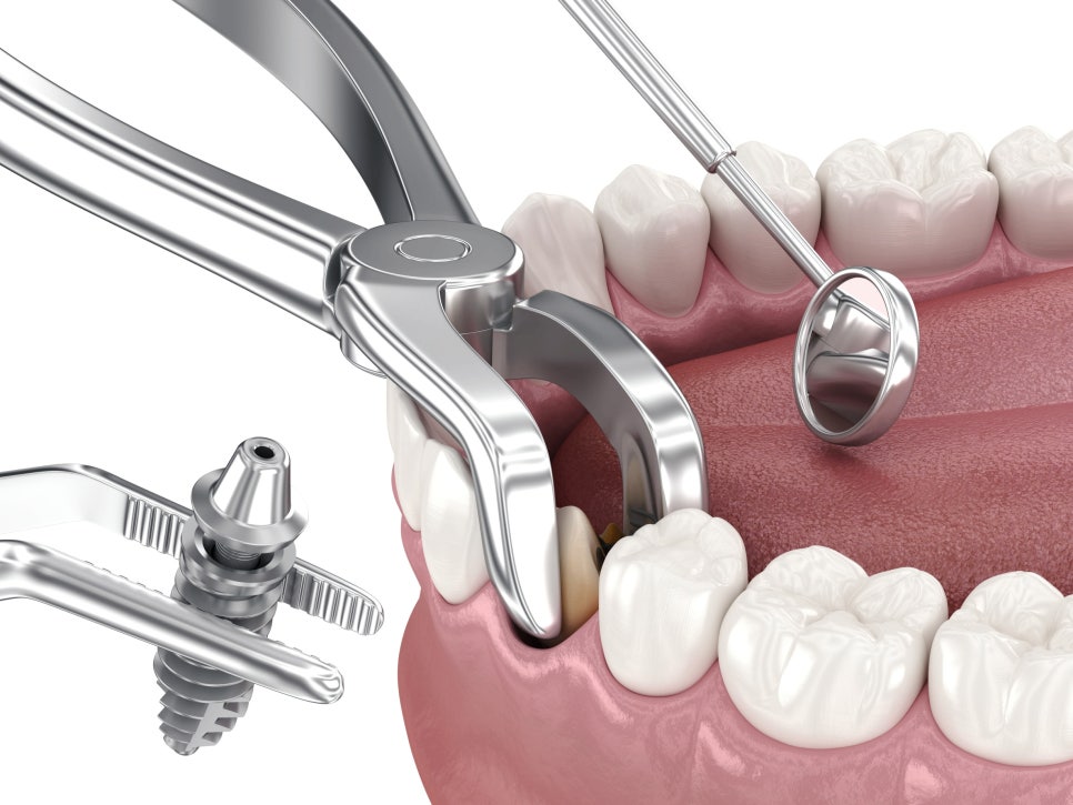 마곡동치과_1. 임플란트 치료에 관련 이미지 6