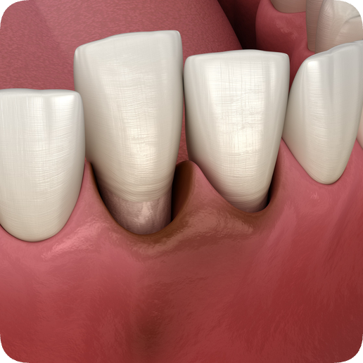 마곡동치과_ "자연치아 지키는 골든타임" [ 1. 신경치료 꼭 받아야 하는 5가지 경우 ] 관련 이미지 6