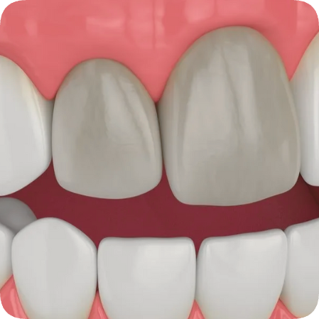 마곡역치과_ 신경이 죽은 치아를 다시 하얗게! [ 2. 실활치 미백&rsquo;의 원리와 과정 ] 관련 이미지 1