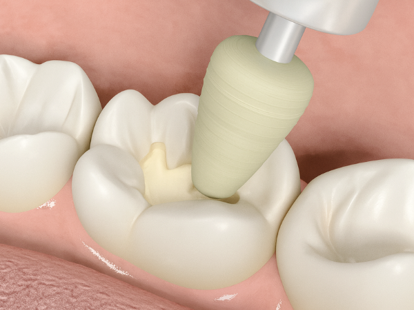 마곡역치과_ 1. 글래스아이오노머(GI) 특징과 장단점 관련 이미지 9