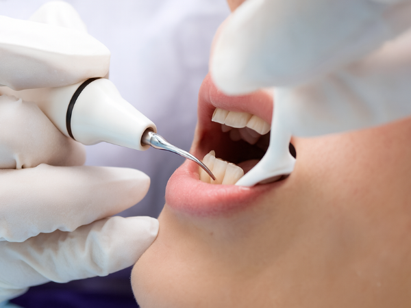 마곡치과_" 짧은 시간, 확실한 톤업" [2. 생활치 전문가 미백치료 특징과 과정 관련 이미지 3