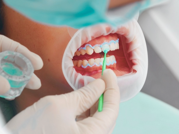 마곡치과_" 짧은 시간, 확실한 톤업" [2. 생활치 전문가 미백치료 특징과 과정 관련 이미지 1