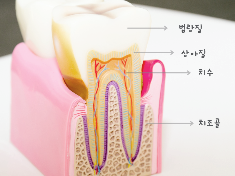 마곡역치과_1. 치수염이란? 치아 속 신경에 염증이 생기는 이유 관련 이미지 2