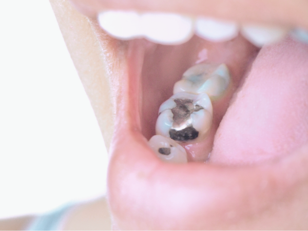 마곡치과_2. 오래된 아말감, 언제 교체해야 할까요? 꼭 확인해야 할 5가지 신호 관련 이미지 5